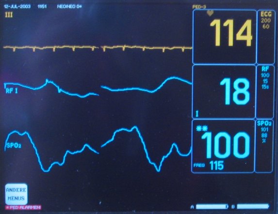 Heart Rate EKG image